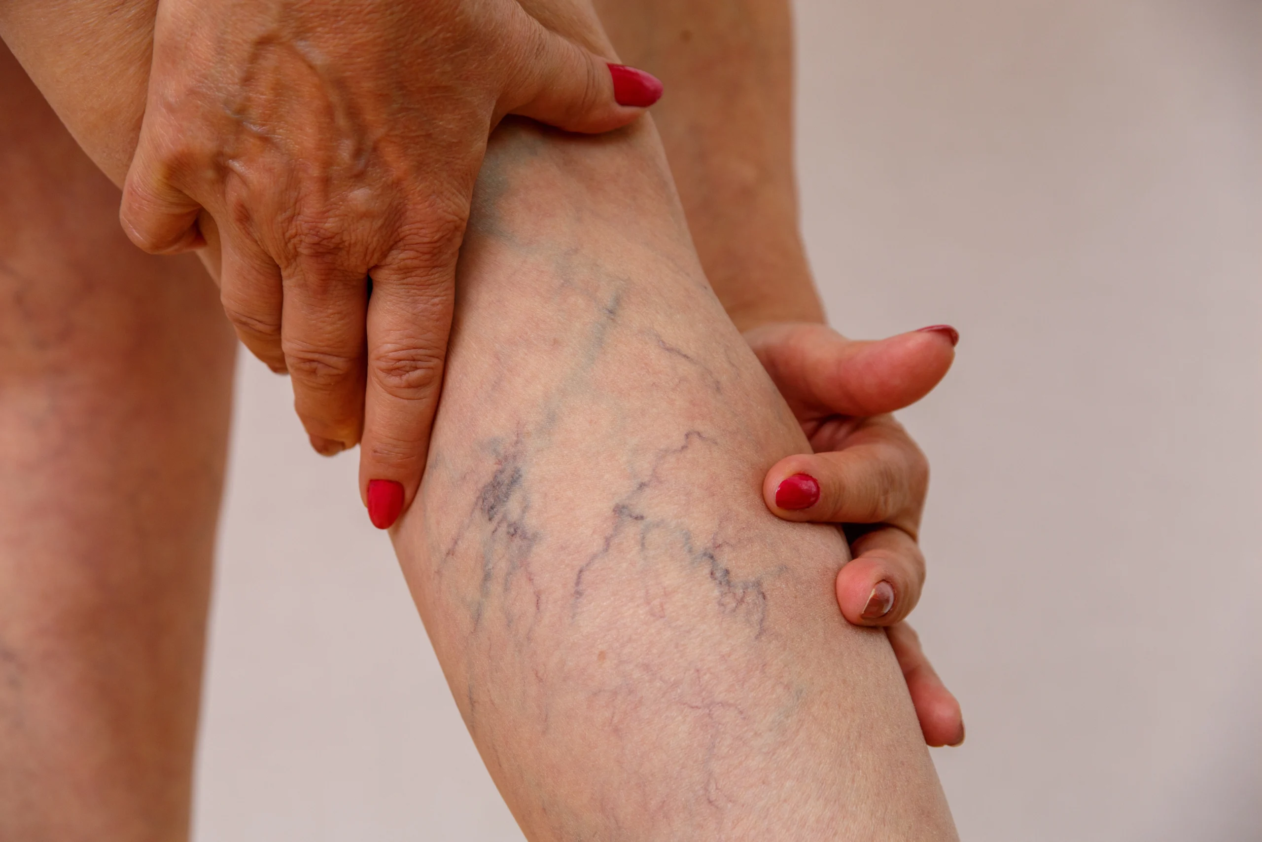 Roberto Reflexoterapeuta | HOME mulher com varizes